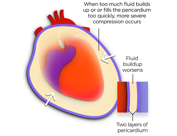 Recurrent Pericarditis Management Treatment