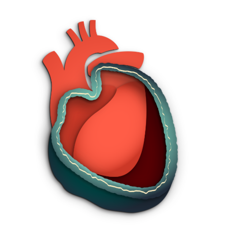 Constrictive pericarditis is the limitation of the hearts ability to pump due to scaring and stiffening of the pericardium.