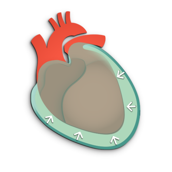 Cardiac tamponade is the build up of fluid that causes the heart to improperly pump due to pressure.