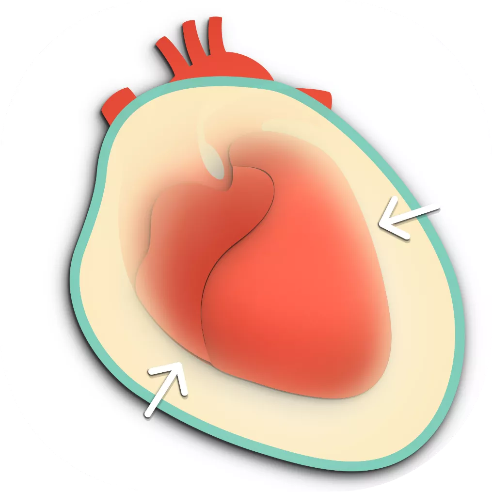 Cardiac tamponade graphic