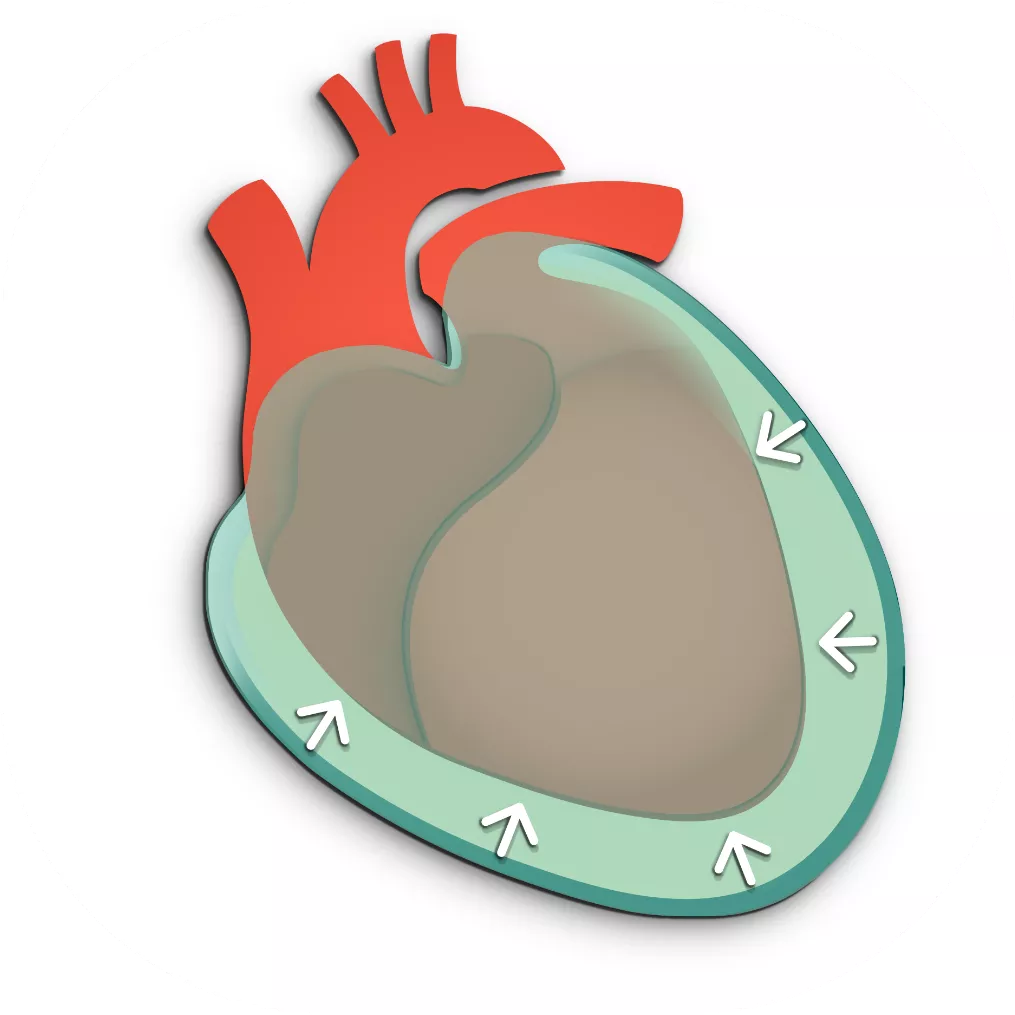 Pericardial effusion graphic