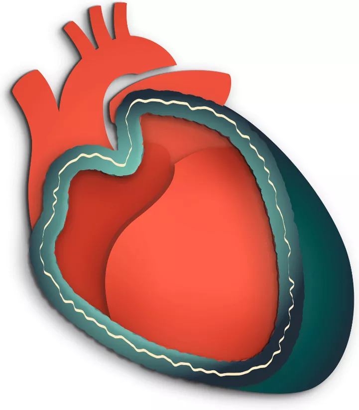 Definition of pericarditis image - swollen, inflamed pericardium